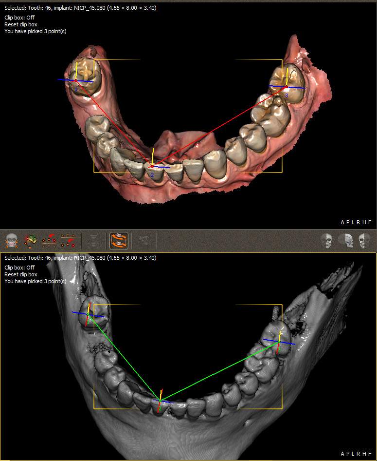 CBCT matching STL